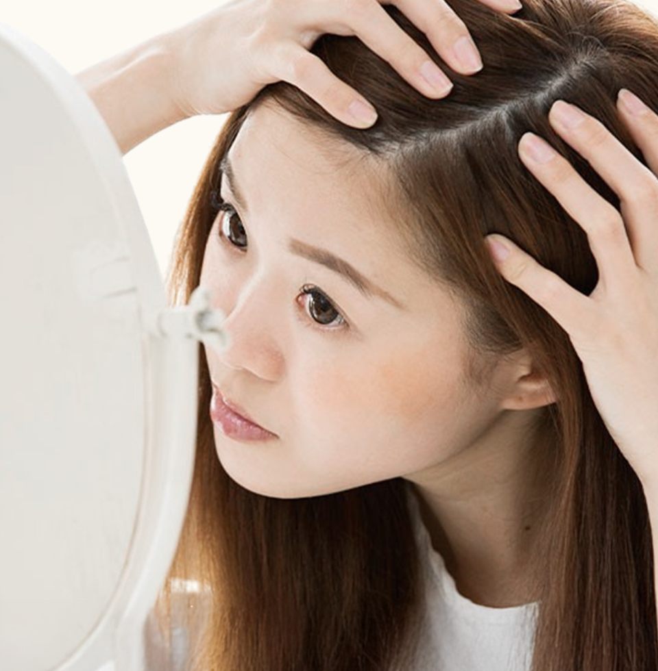 薄毛（女性FAGA）