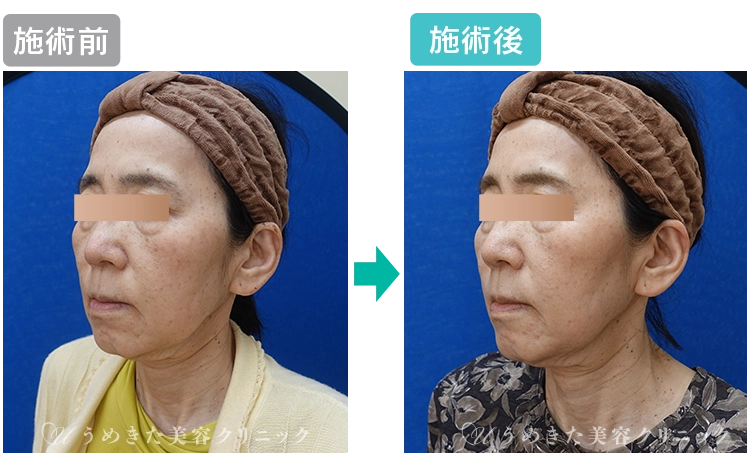 60代女性施術前写真