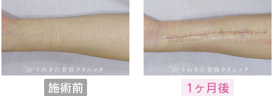 施術前～1ヶ月後