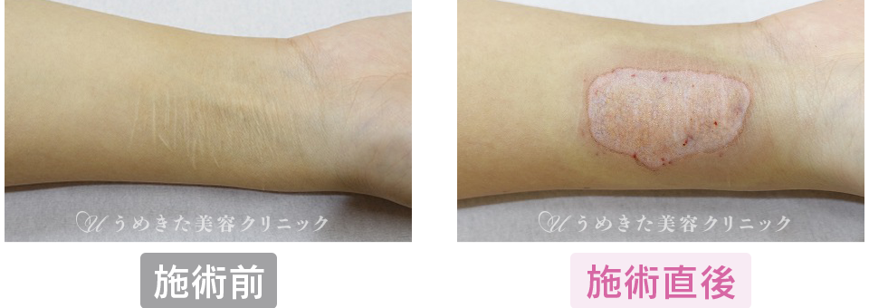 施術前～施術直後