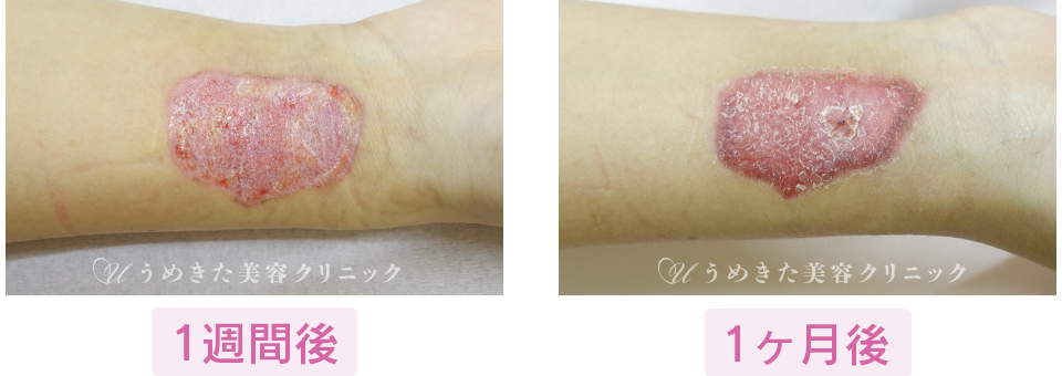 1週間後～1ヶ月後