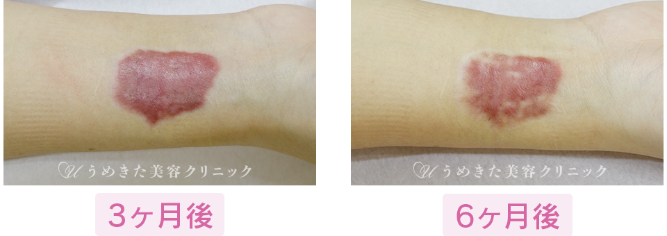 3ヶ月後～6ヶ月後