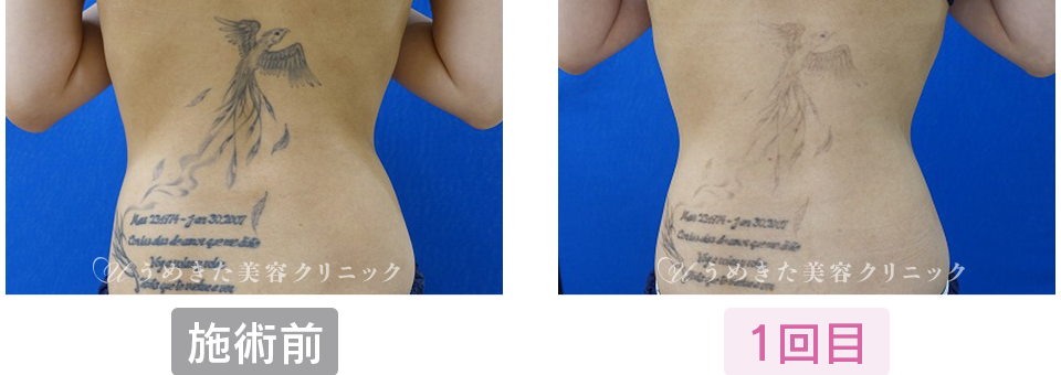 施術前〜1回目