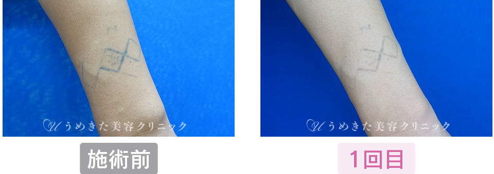 施術前〜1回目