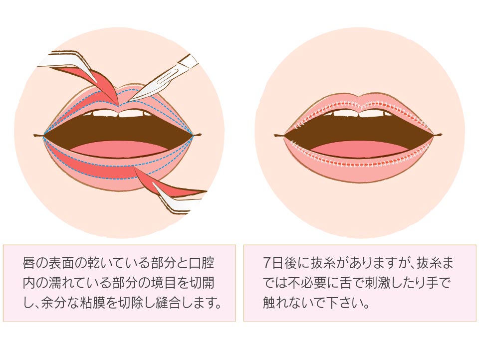 治療（手術方法）について