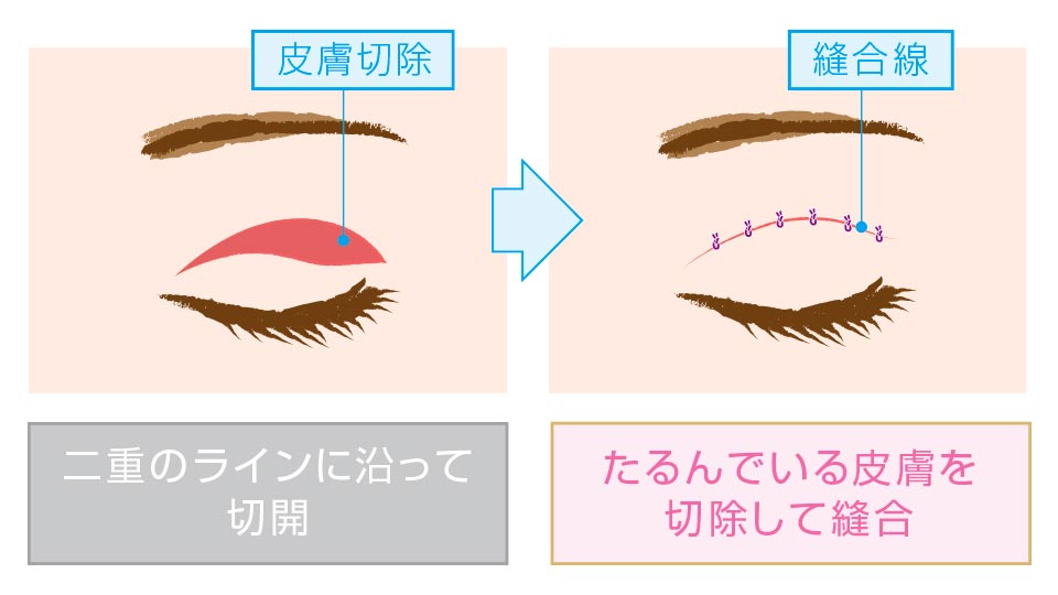 治療（手術方法）について